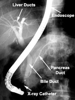 X-ray detailing location of Liver, Pancreas and Bile ducts and position of endoscope and x-ray catheter X-ray detailing location of Liver, Pancreas and Bile ducts and position of endoscope and x-ray catheter